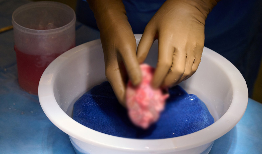 First-ever living human receives Pig kidney transplant successfully